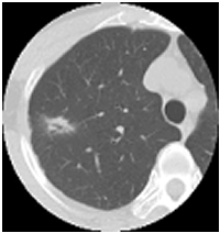 ヘリカルCT画像