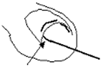 弾性ワイヤーを入れる