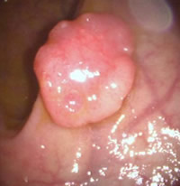 直腸にできた腫瘍（早期癌）