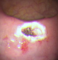 大腸内視鏡下腫瘍切除後