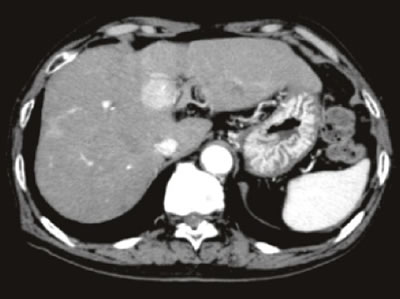 腹部肝細胞がん