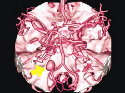 脳動脈癌・動静脈癌